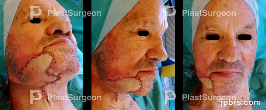 BCC excision and flap definition