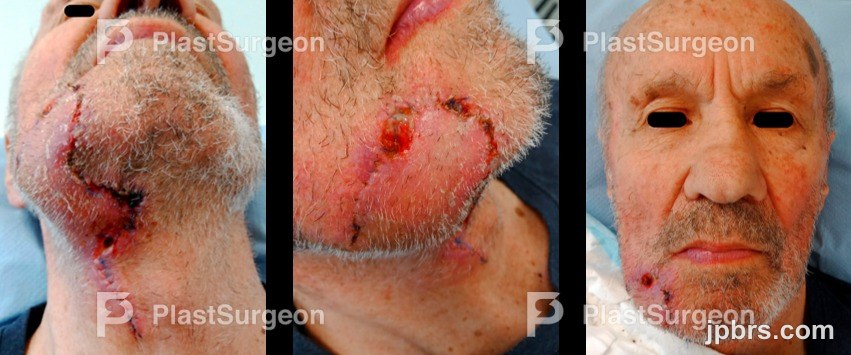 Flap elevation and inset