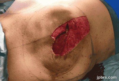 After De-epithelialization