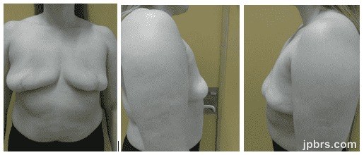 One Year postoperative follow-up