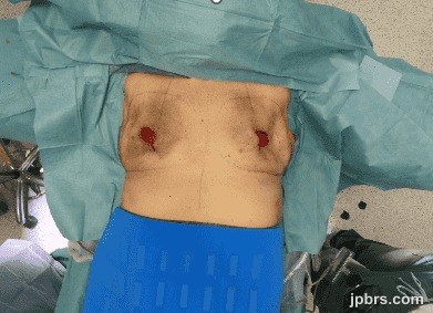Skin envelopes after subcutaneous mastectomy