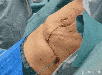 Closure of horizontal incisions