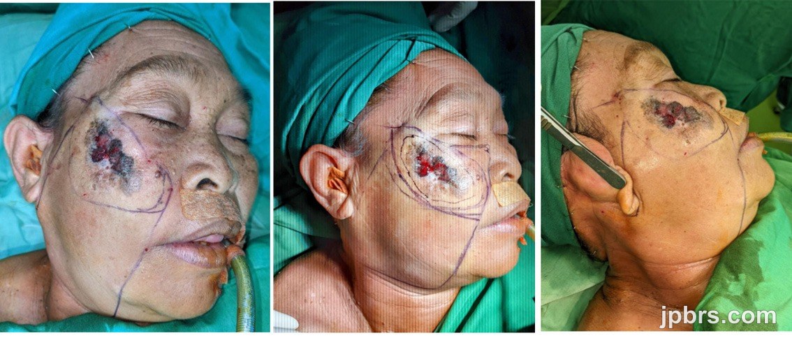 Preoperative markings and flap design