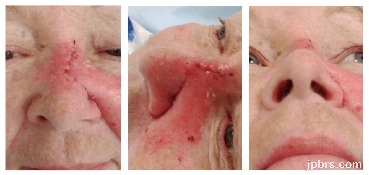 7-Day Postoperative Follow-up