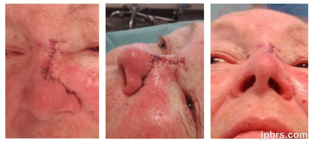 Flap inset and suturing