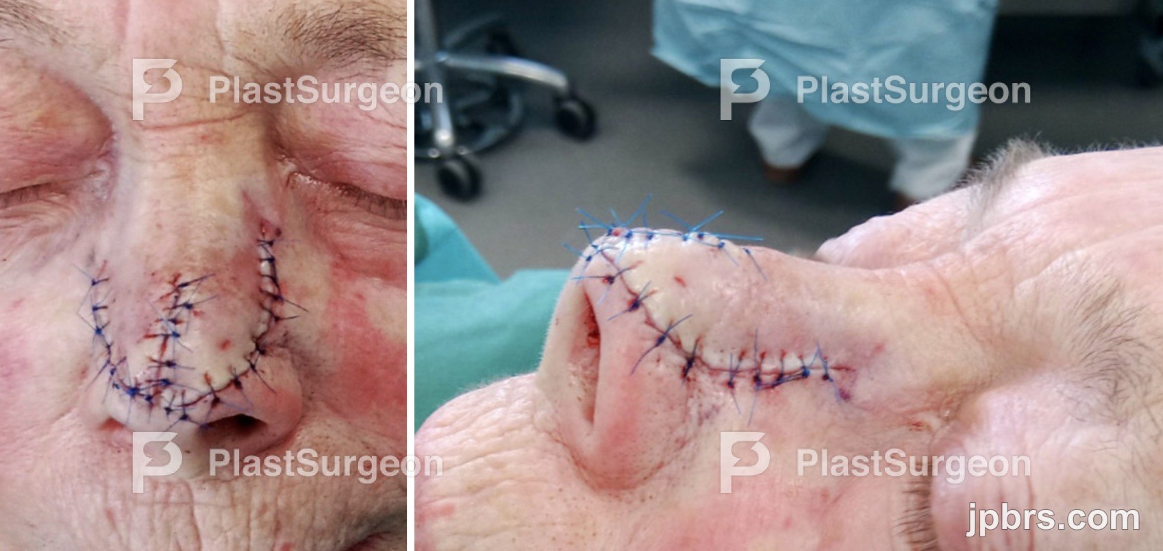 Flap elevation