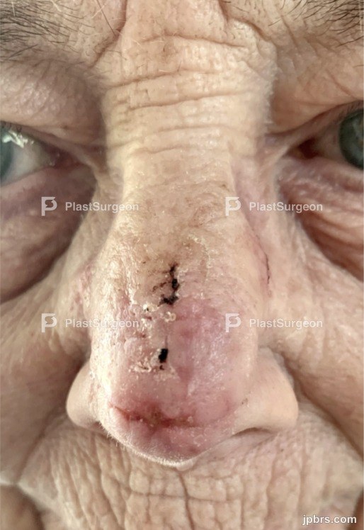 Flap inset