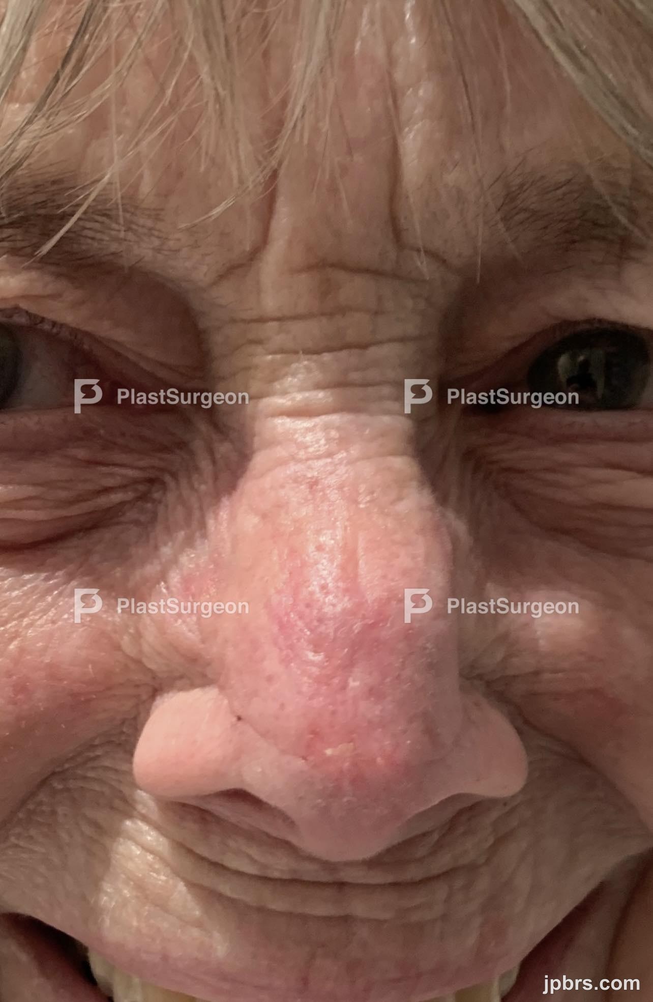 Results 12-day after surgery
