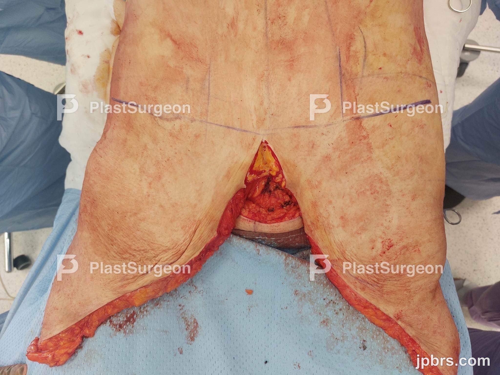 Dissection and umbilical stalk preservation