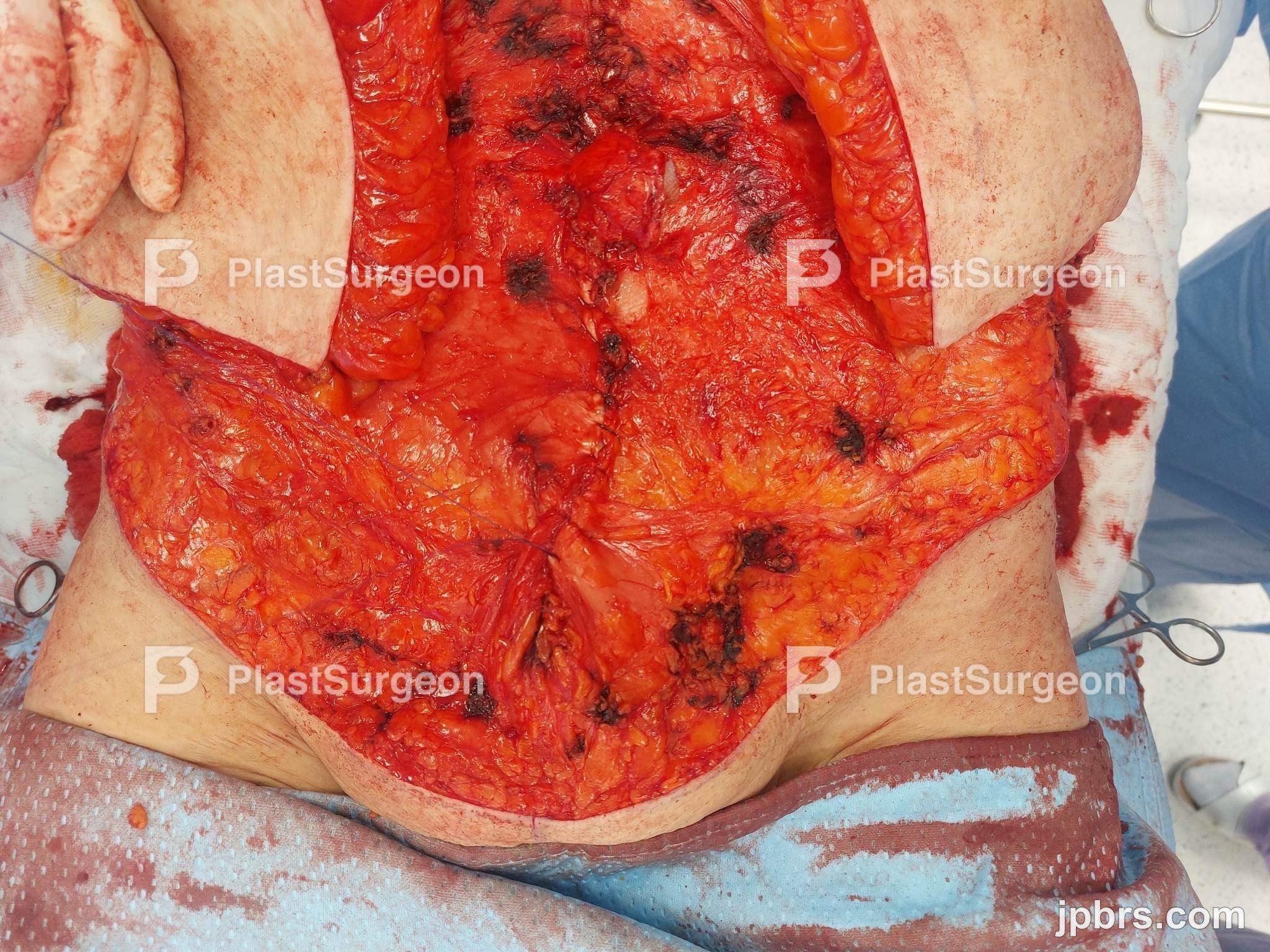 V shape and vertical incisions, en bloc resection