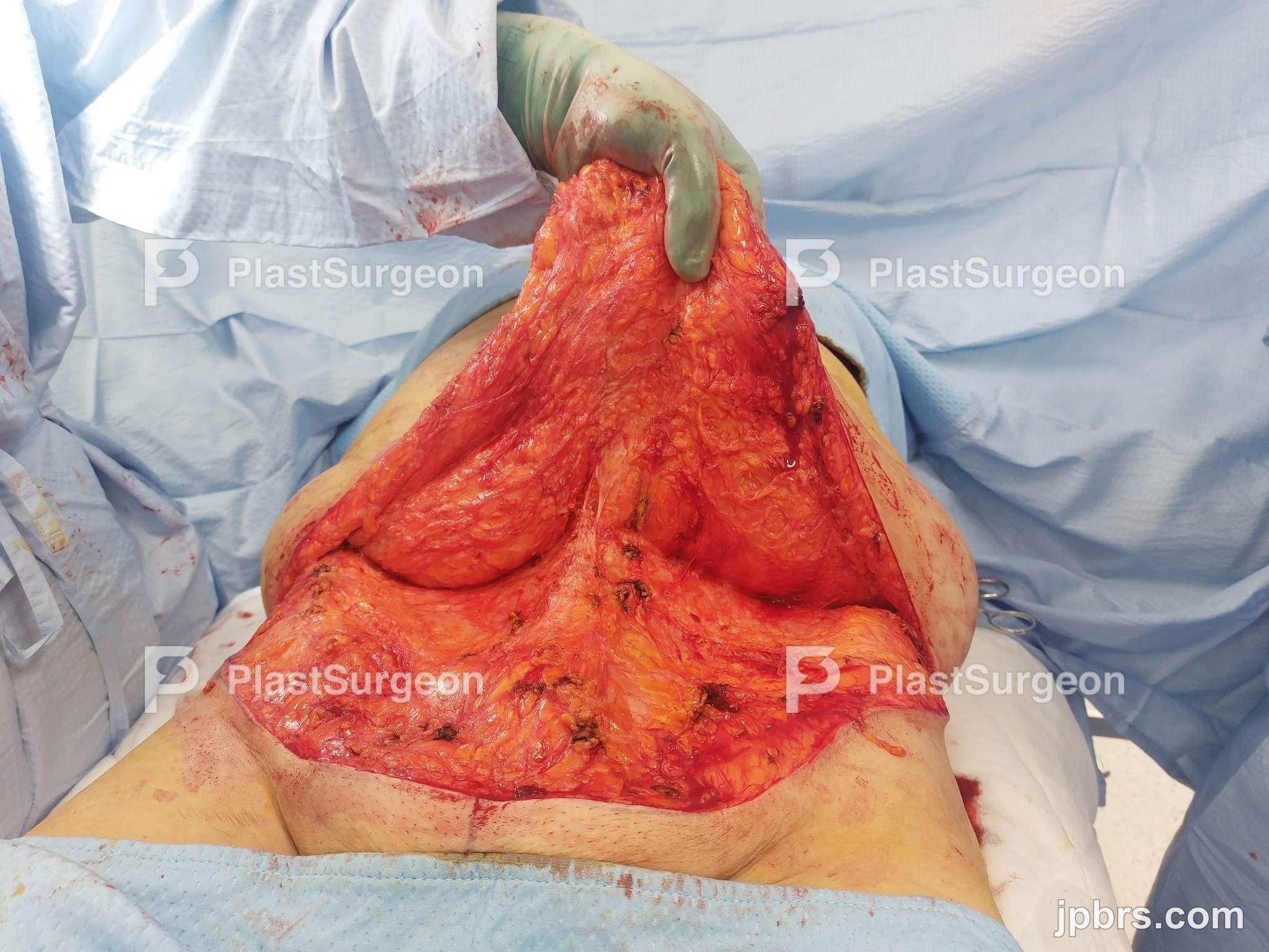 Horizontal resection