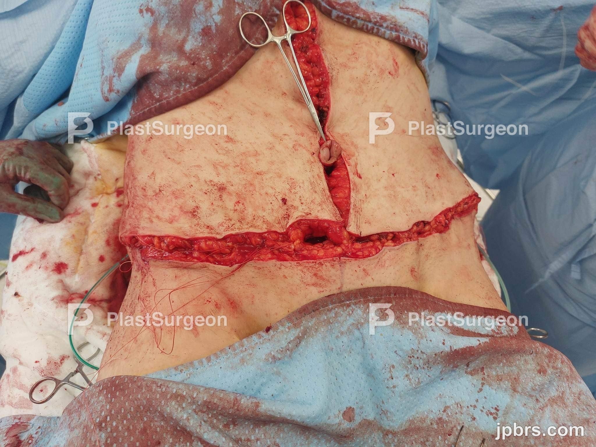 Diastasis recti repair