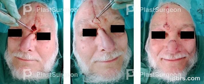 Pre-flap division 34 days postoperative
