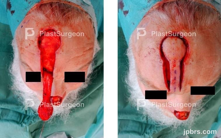 Flap definition