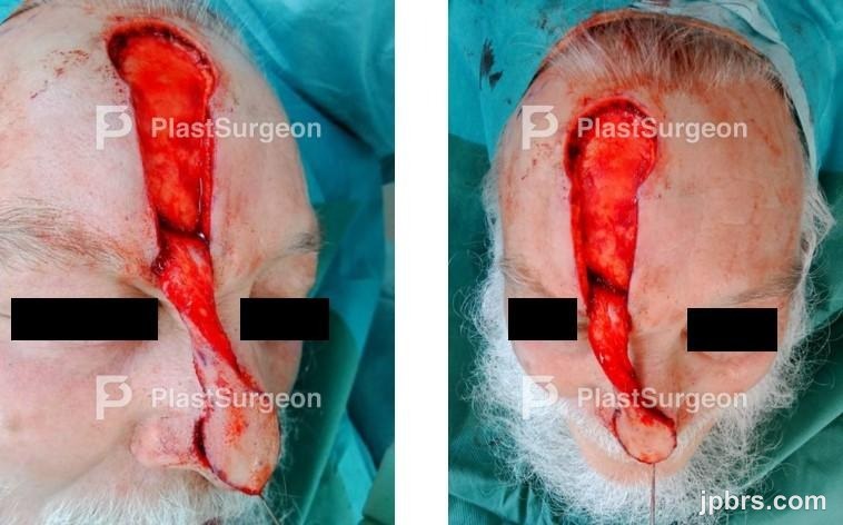 Flap elevation and thinning