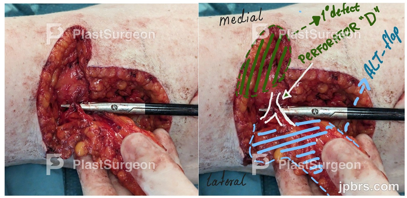 Preoperative markings