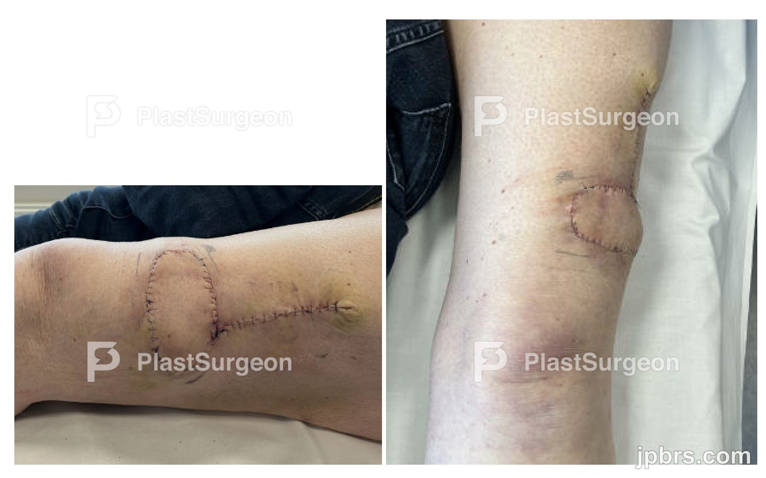 Day 1 after the surgery.