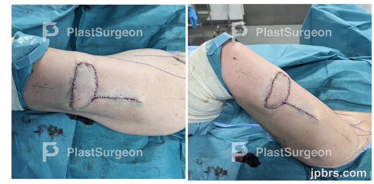 Perioperative measurements and identification of D-POP