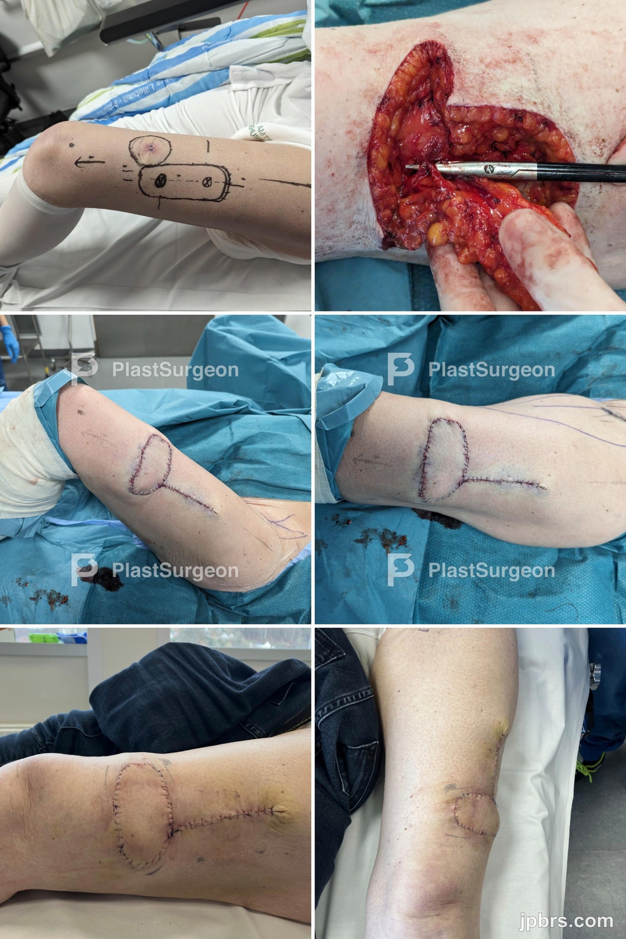 Day 10 after the surgery.