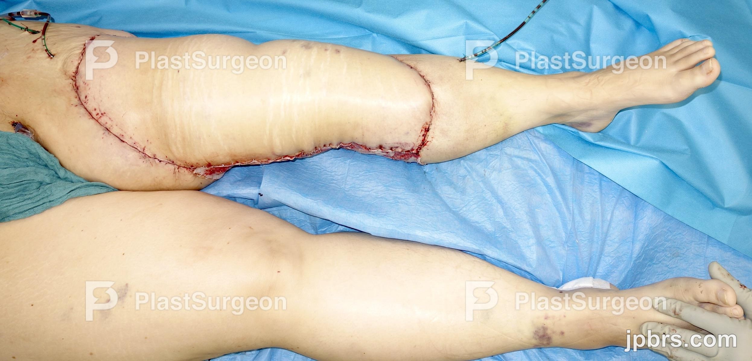 Transplantation of the flap – Preparation of the abdomen