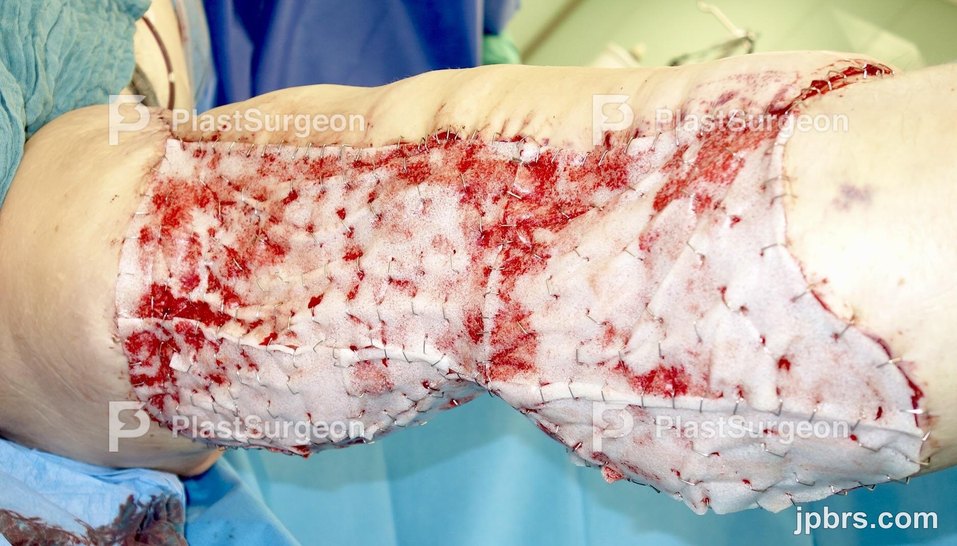 Transplantation of the flap – Positioning of the flap on the ventral left extremity