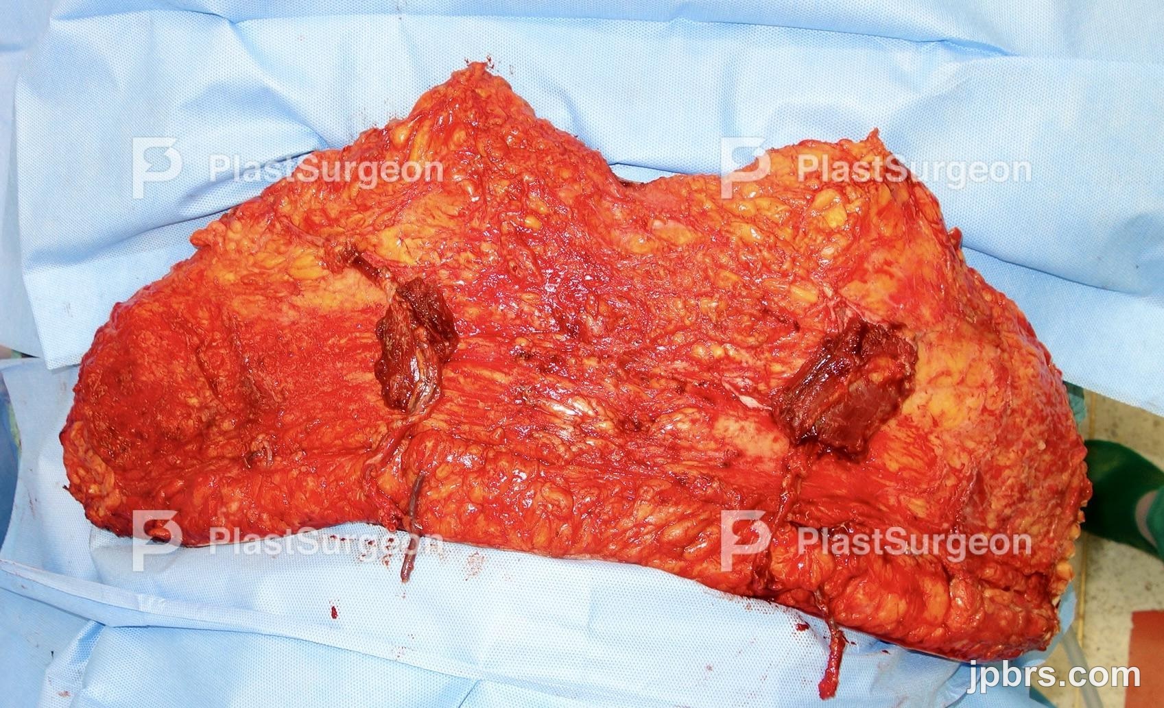 Transplantation of the flap – Preparation of the abdomen