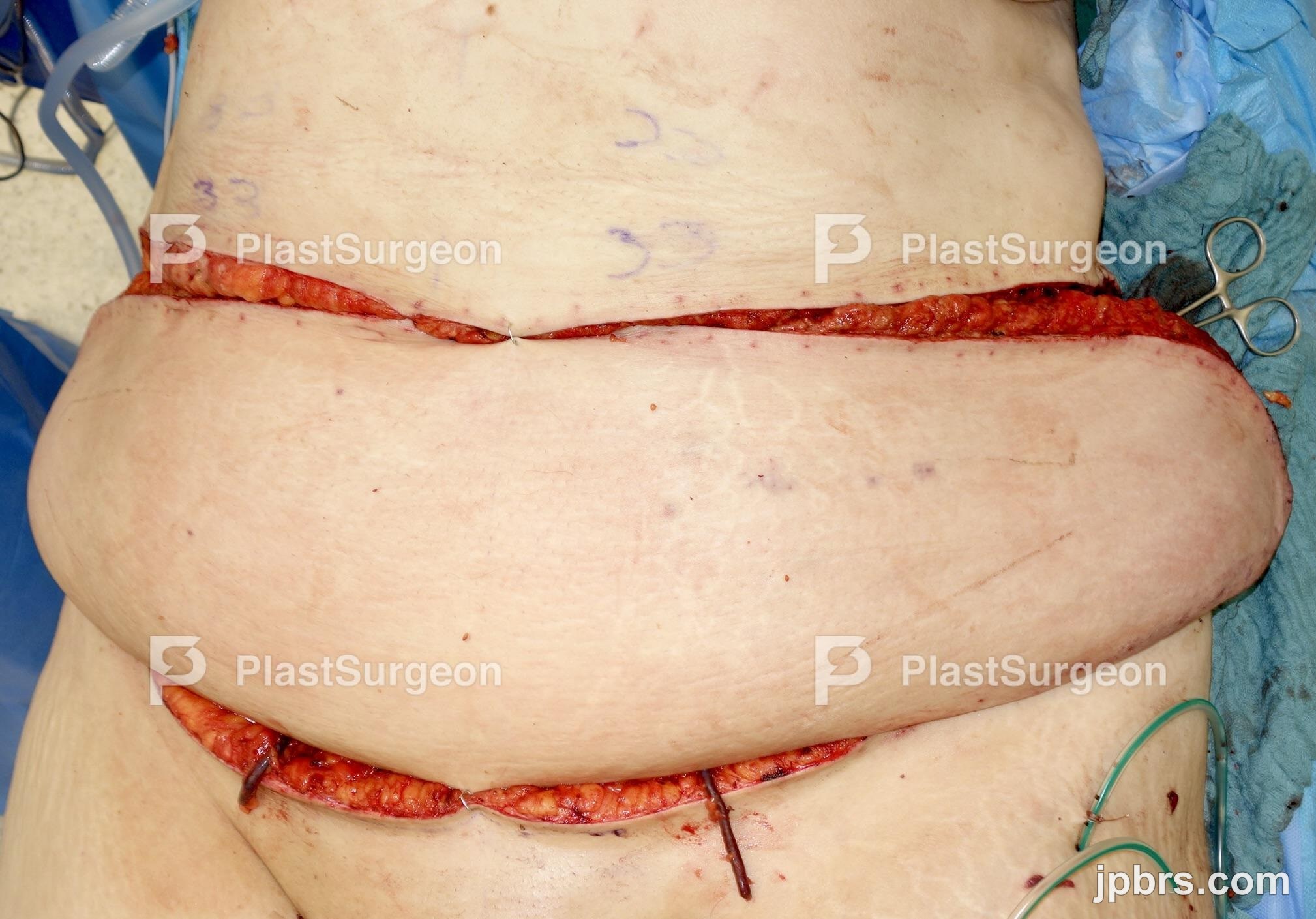 Transplantation of the flap – Preparation of the lower leg and thigh