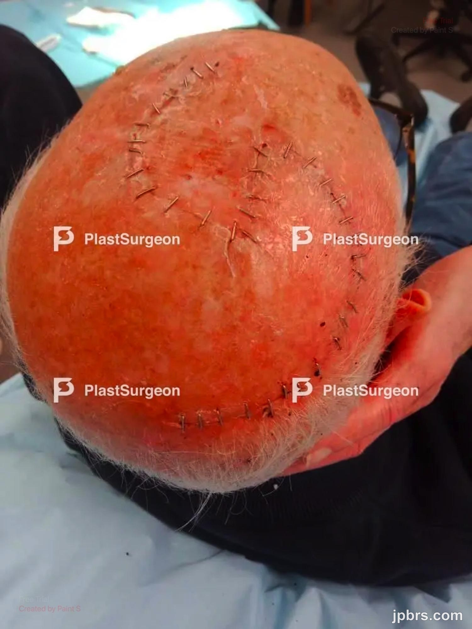 Double rotation flap