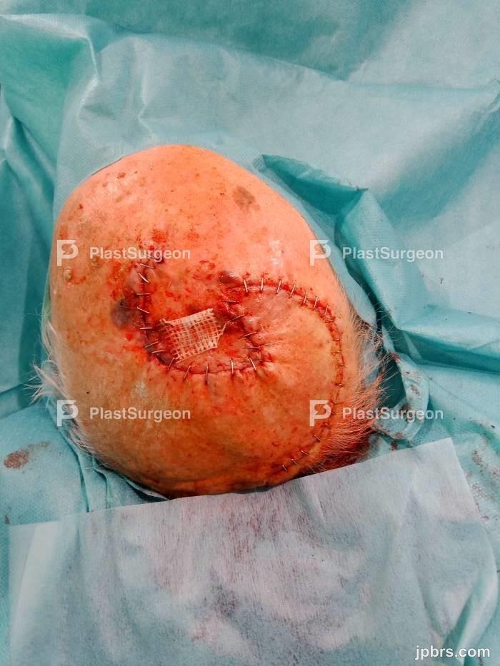 Opening up the scalp skin