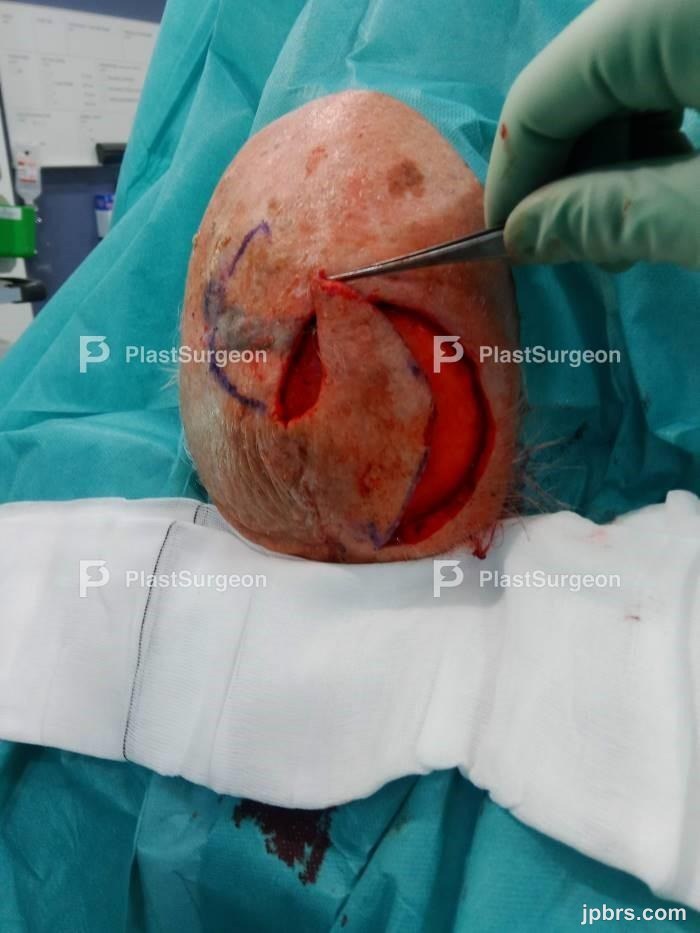 Excision of the tumor