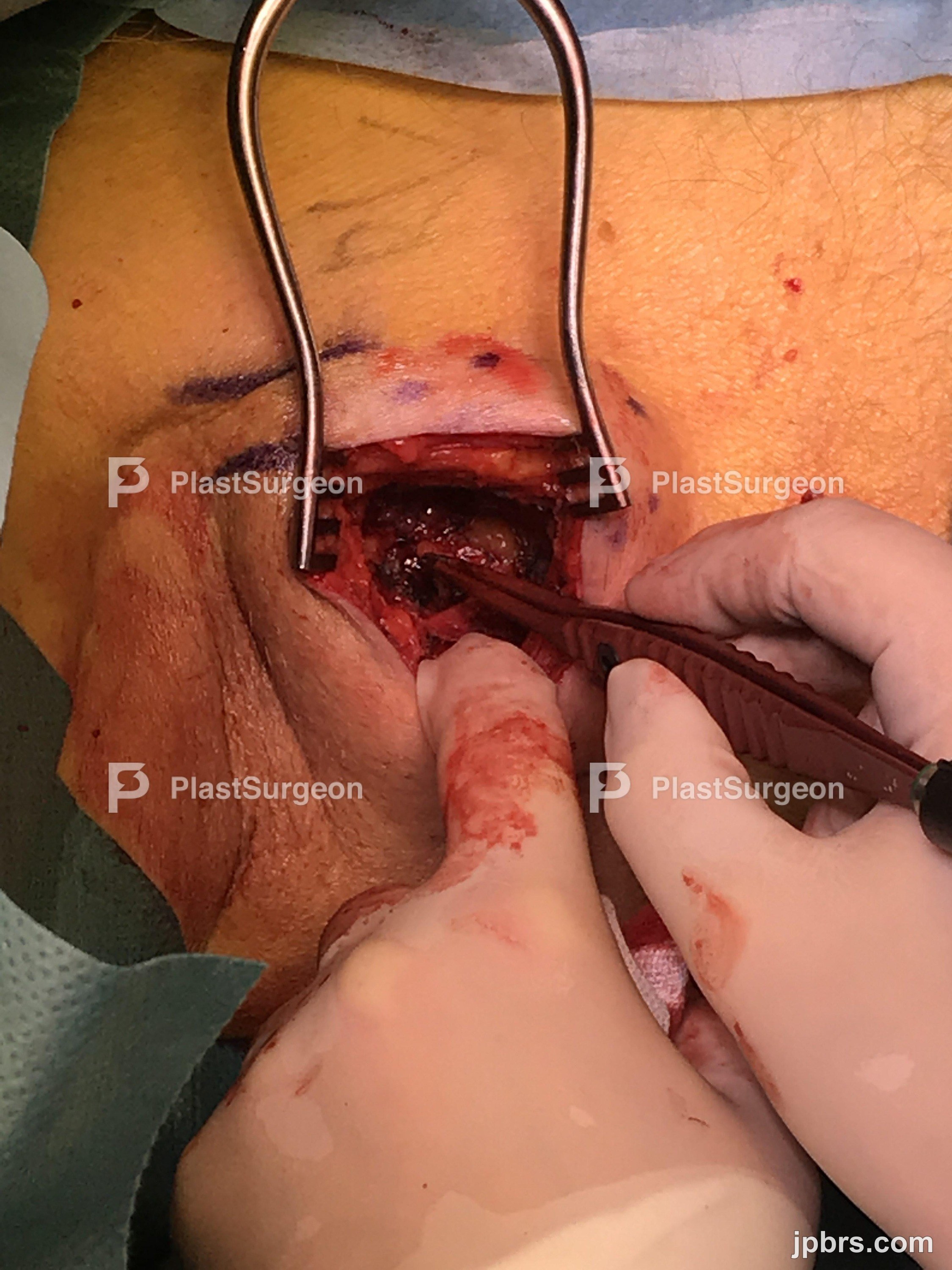 Assessment of lymphnode