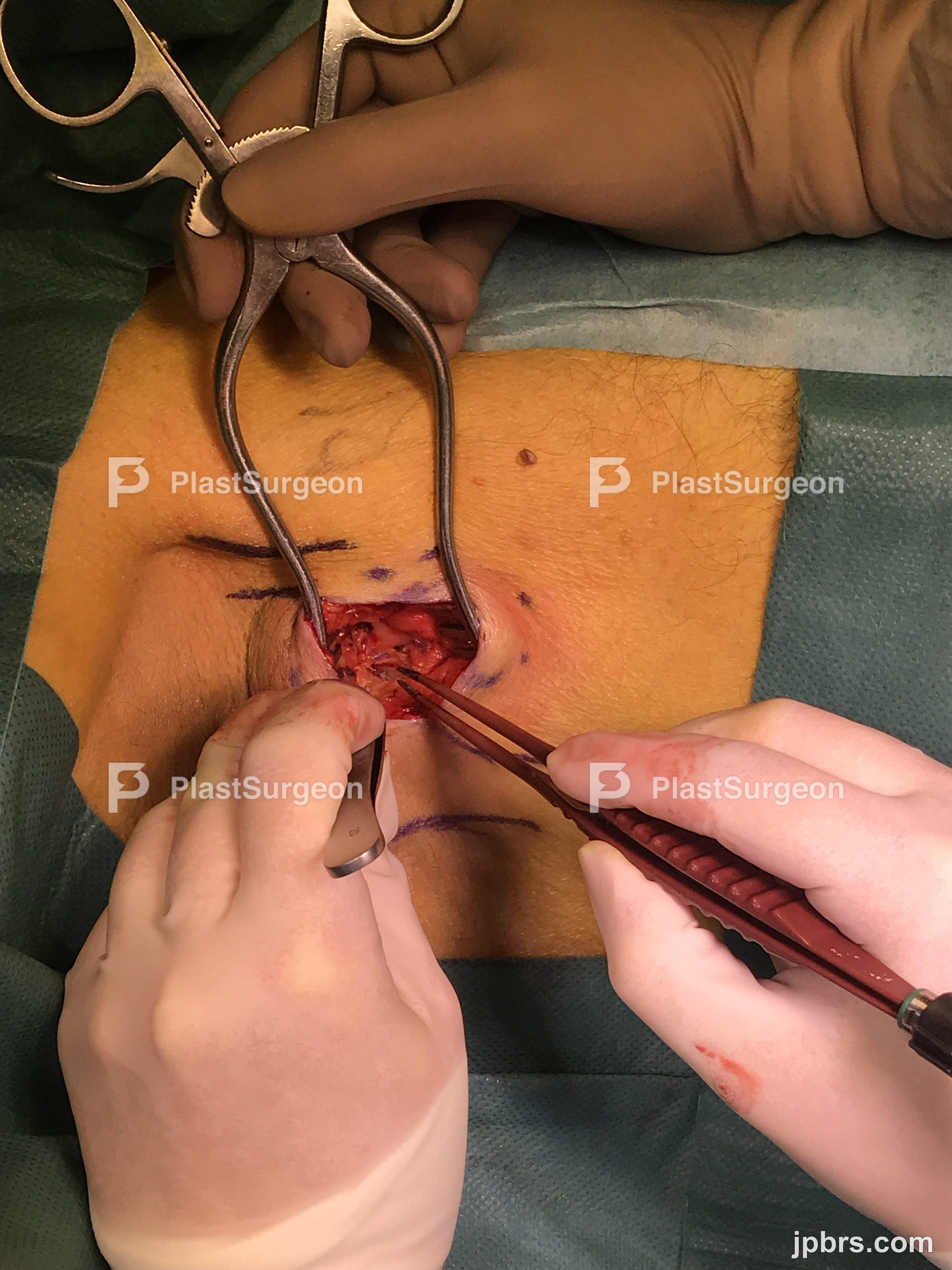 Using retractors