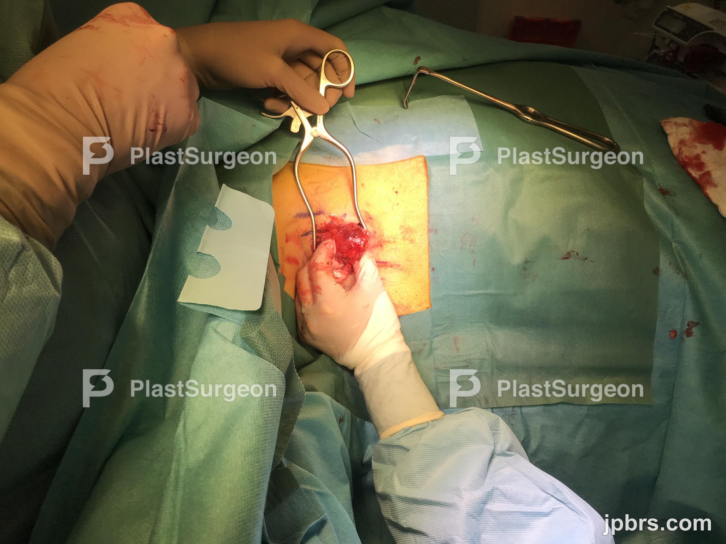 Dissecting using metzenbaum scissors