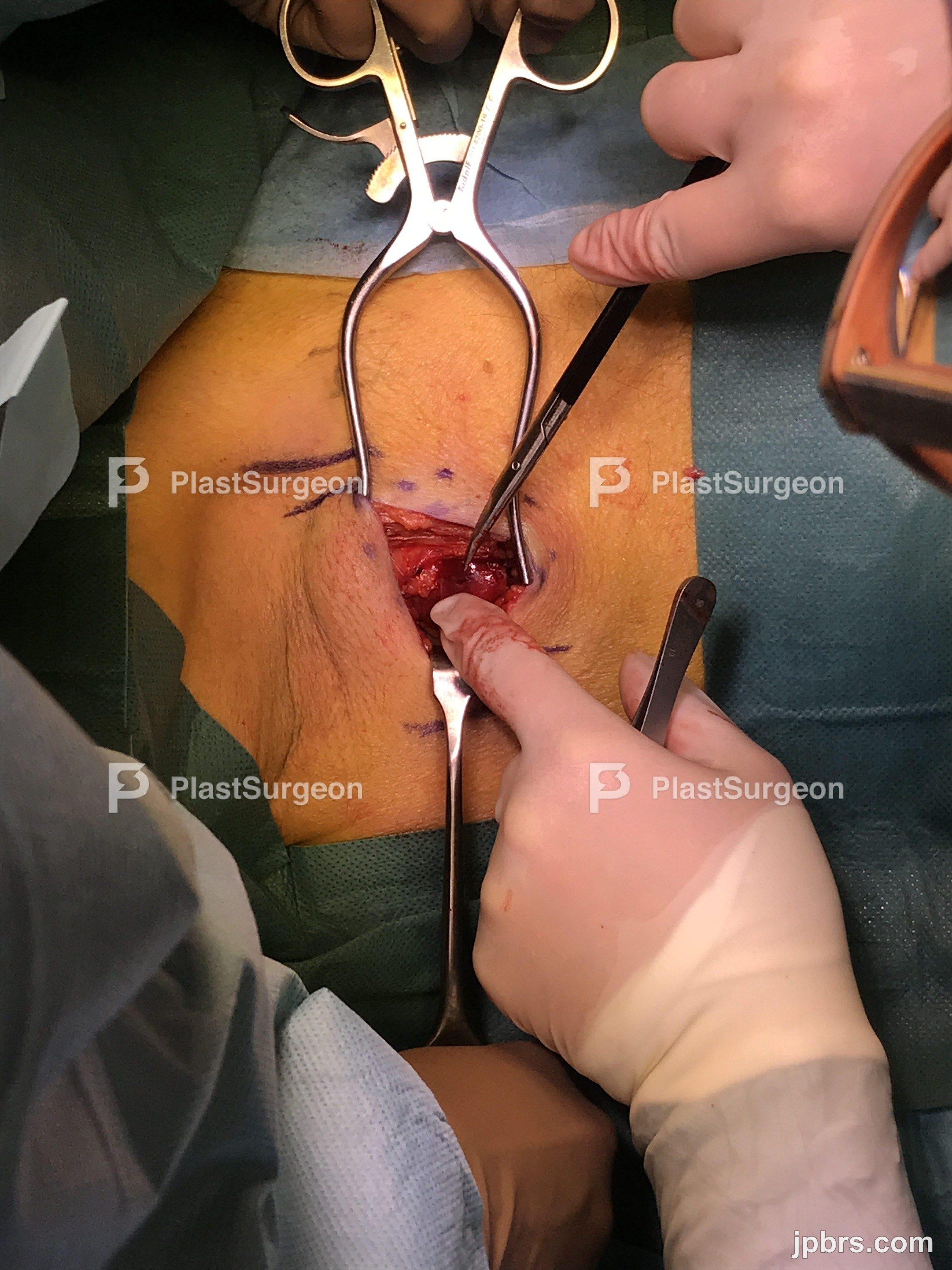Hemostasis using bipolar diathermia