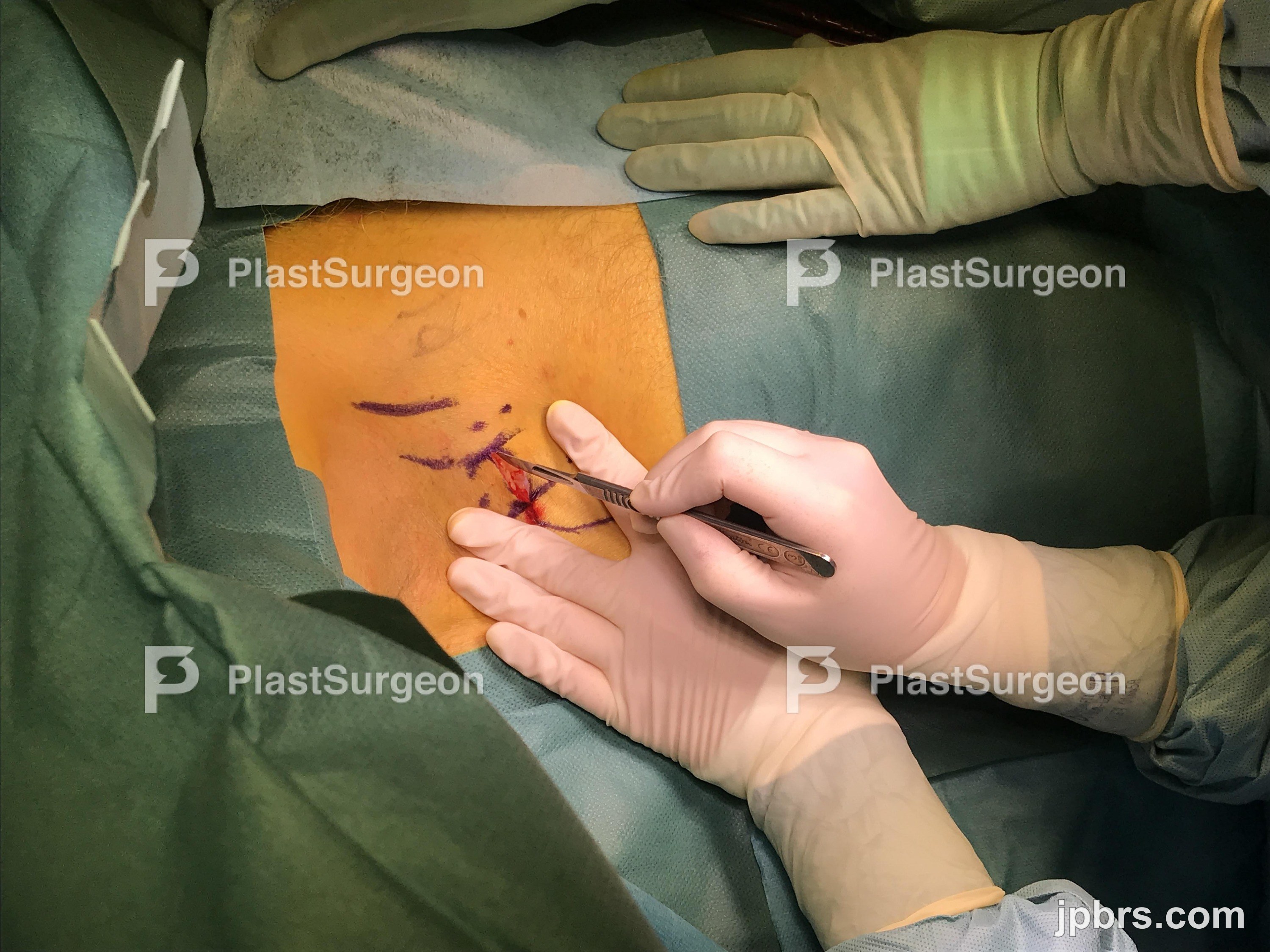 Pre-operative drawing
