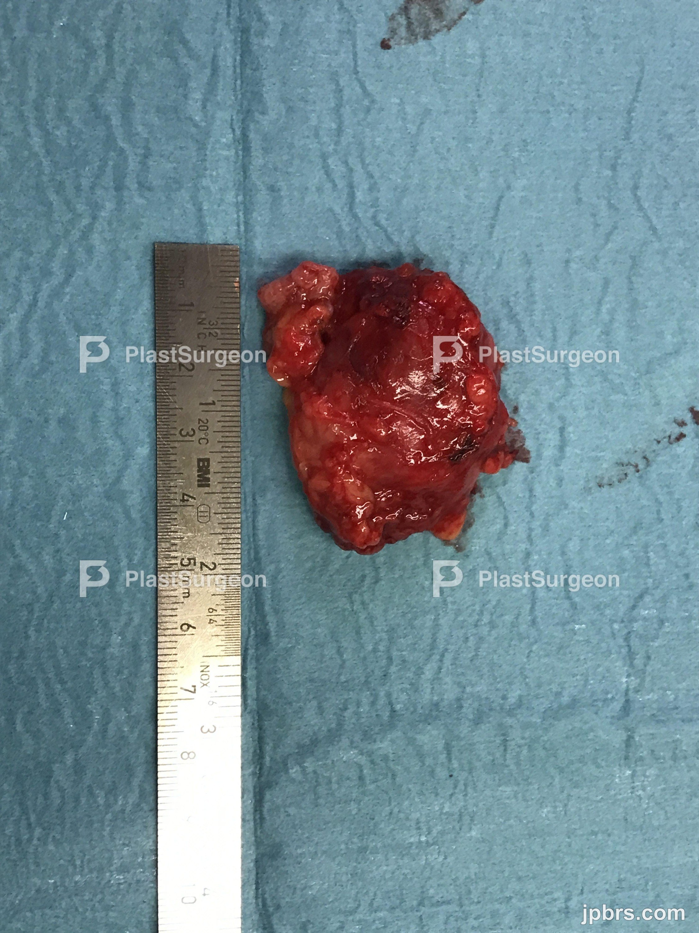 Lymphnode removed