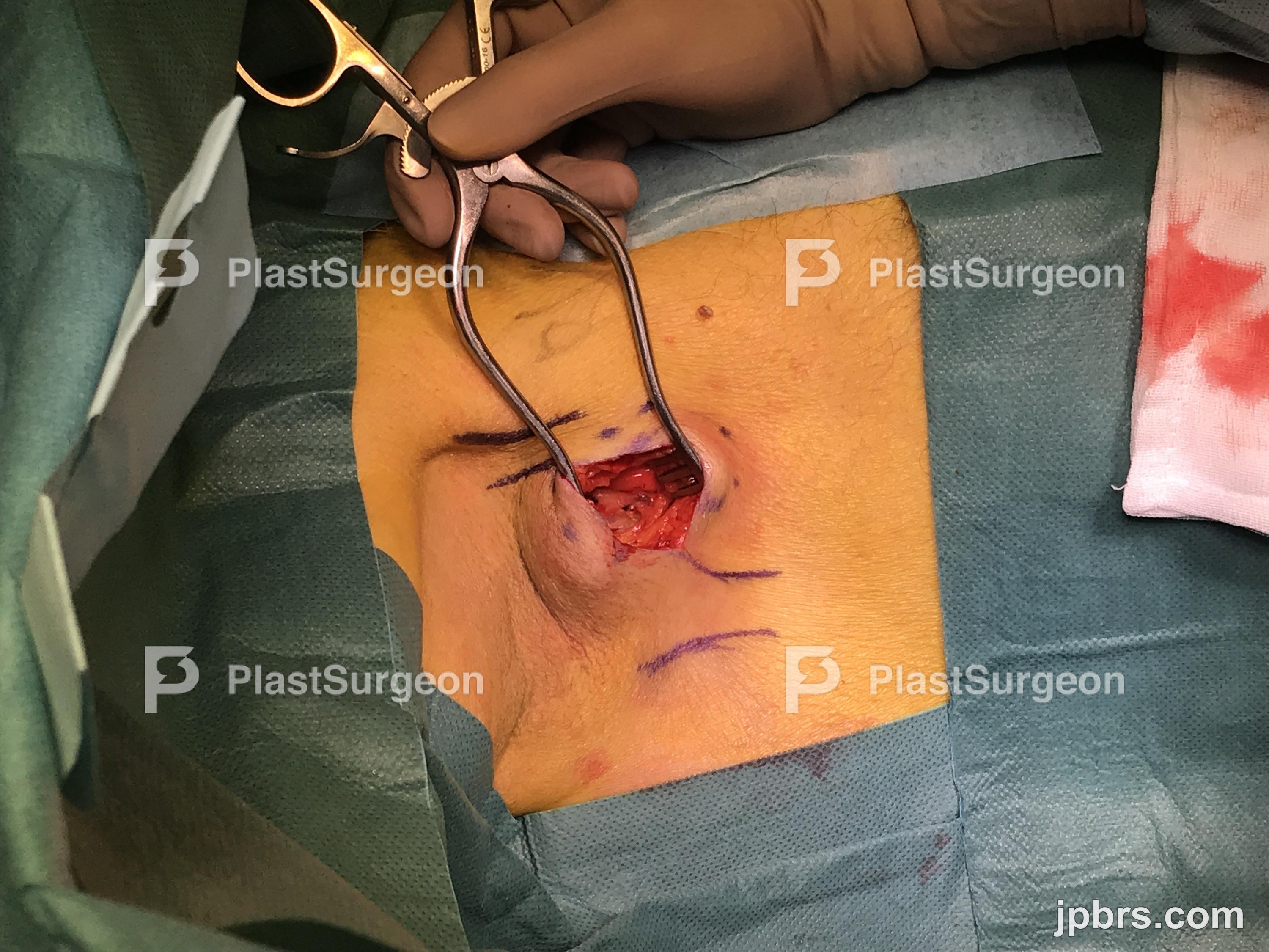 Incision
