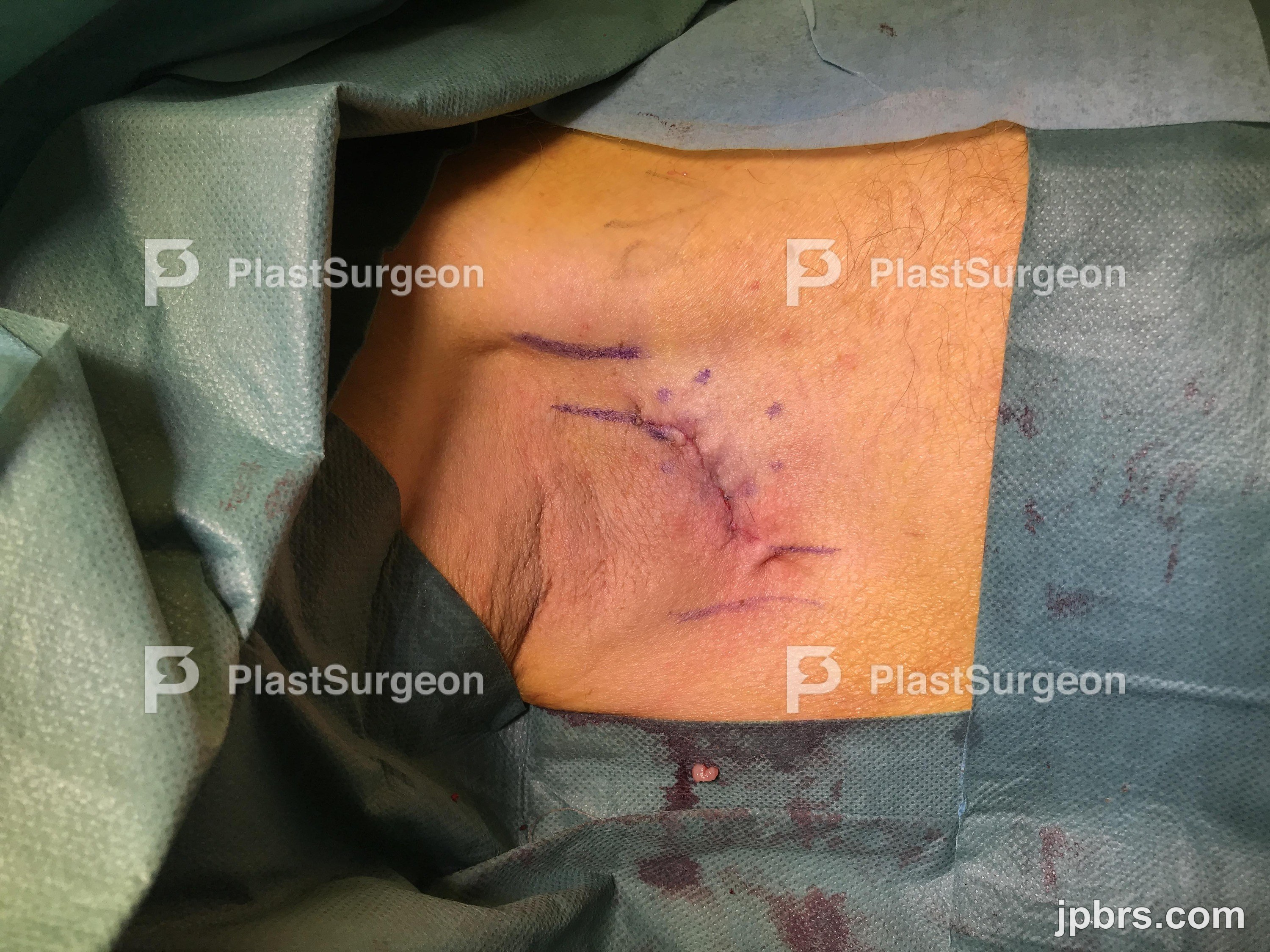 Hemostasis
