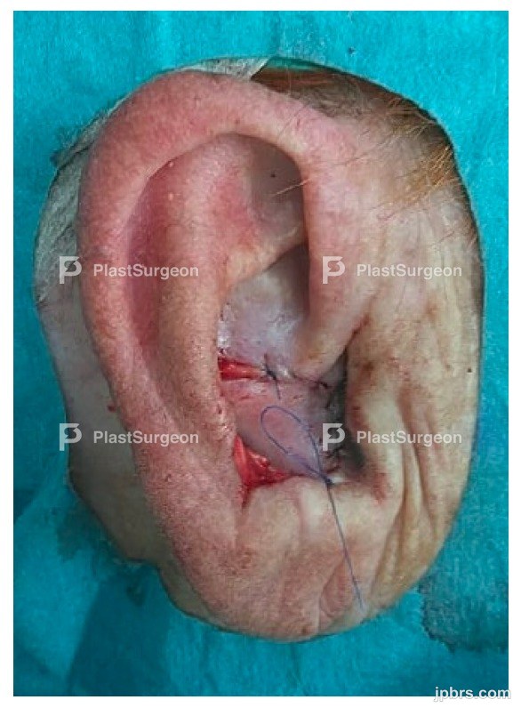 1.stage Flap elevation: antero-medial defect closure
