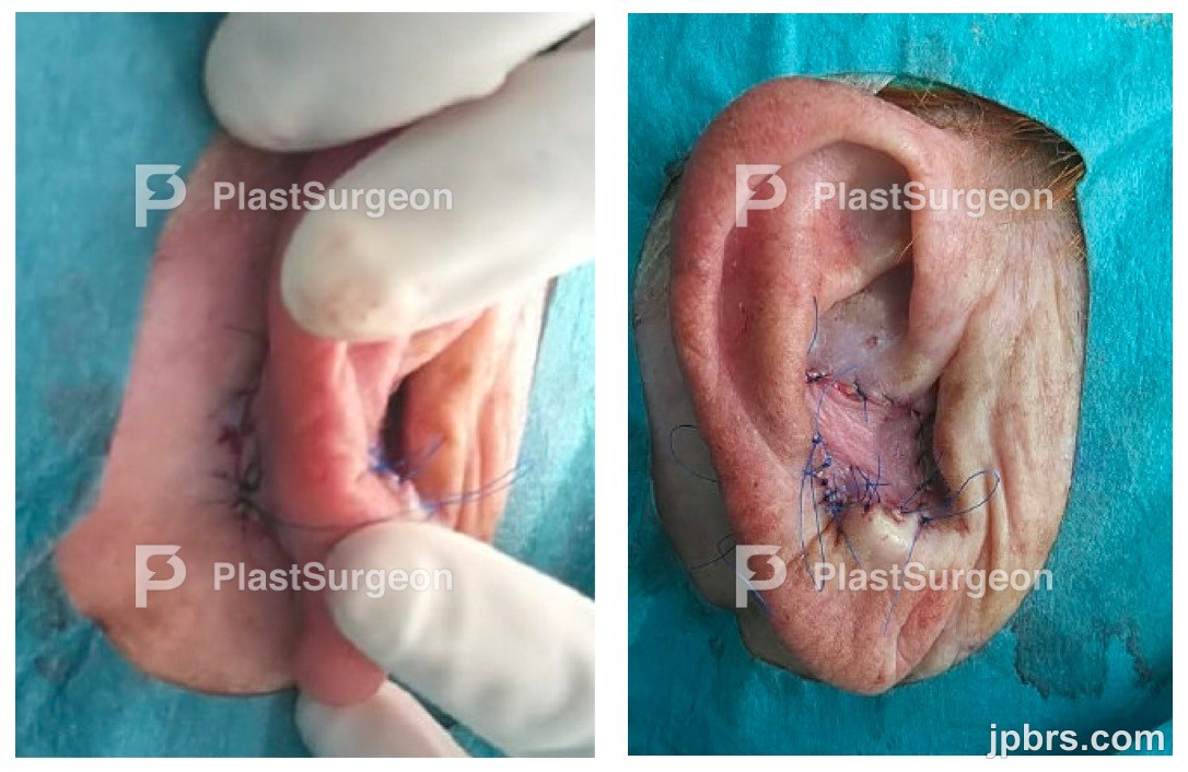 2.stage Flap elevation: posterior + antero-lateral defect closure