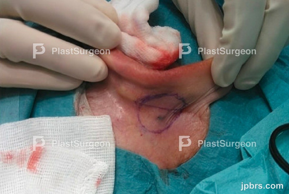 Excision of tumor