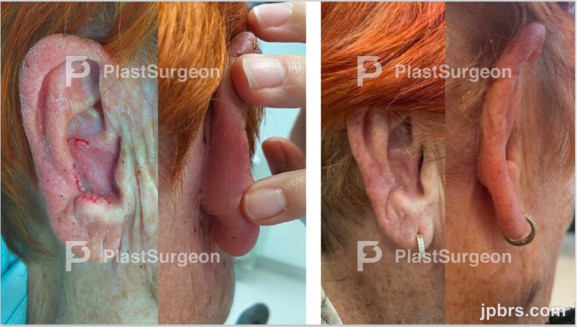 2.stage Suture and final Wound dressing