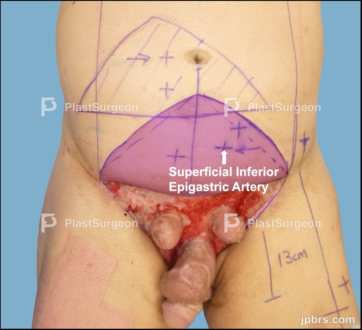 Previous multiple wound bed preparation and skin Grafting attempts