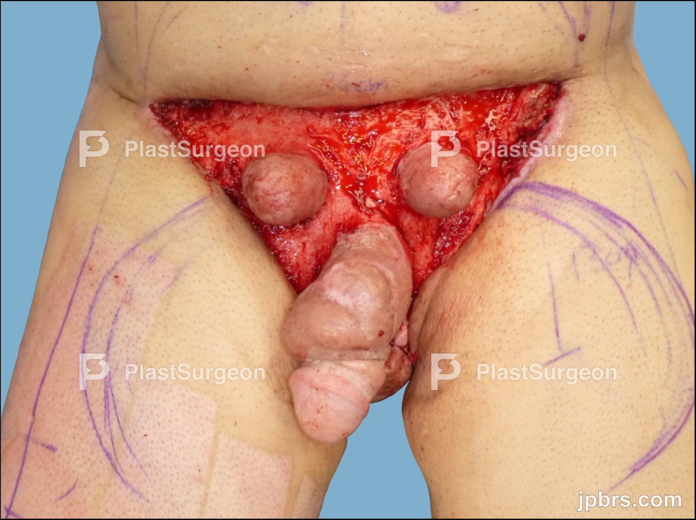 Intra-operative Planning
