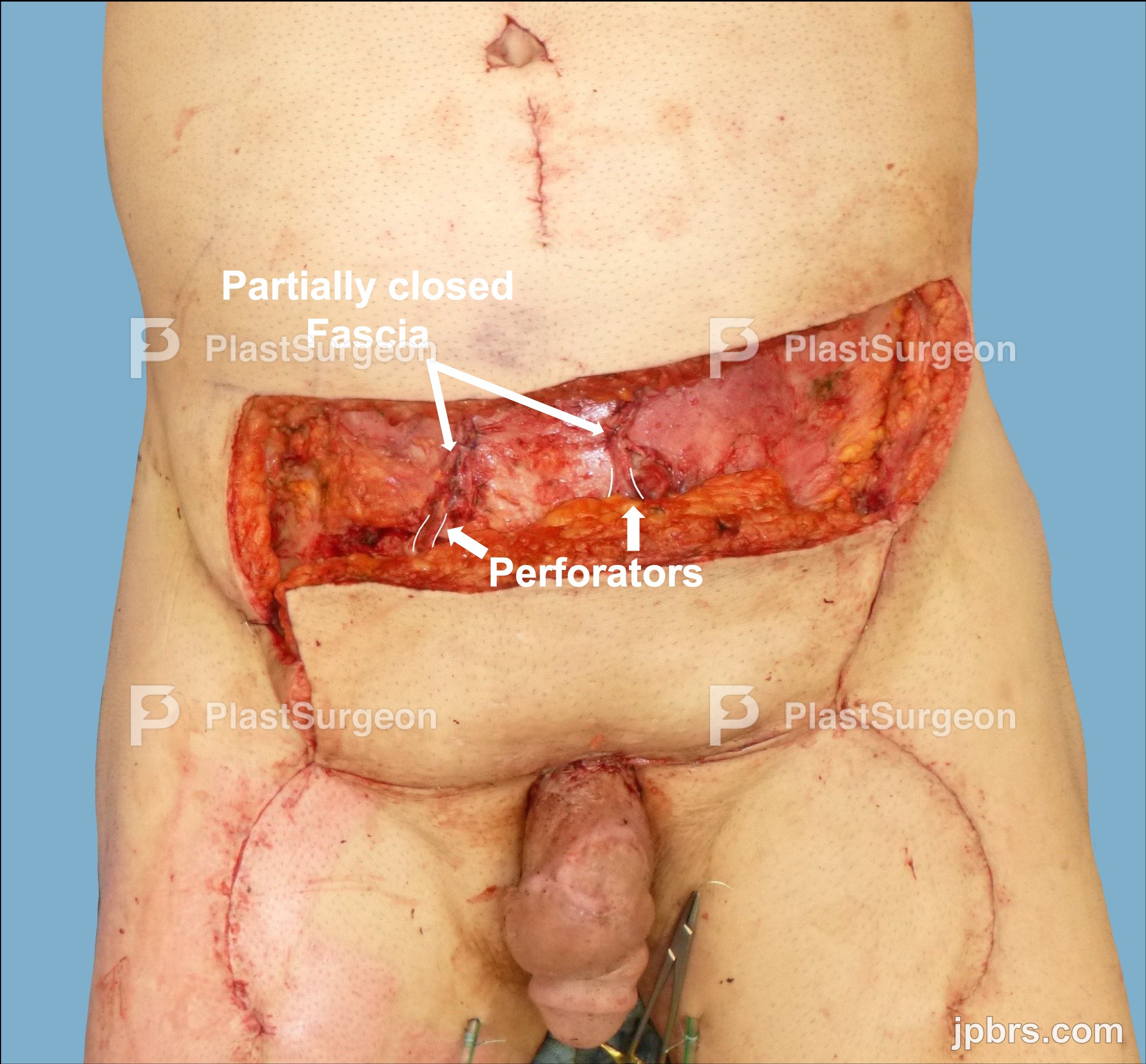 Distal transposition of the flap