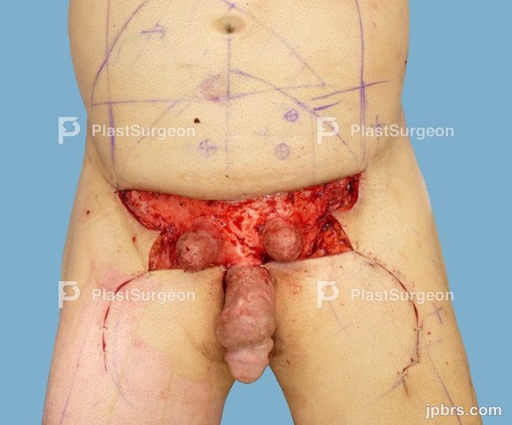Flap dissection: