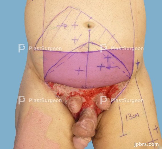 Extensive Debridement
