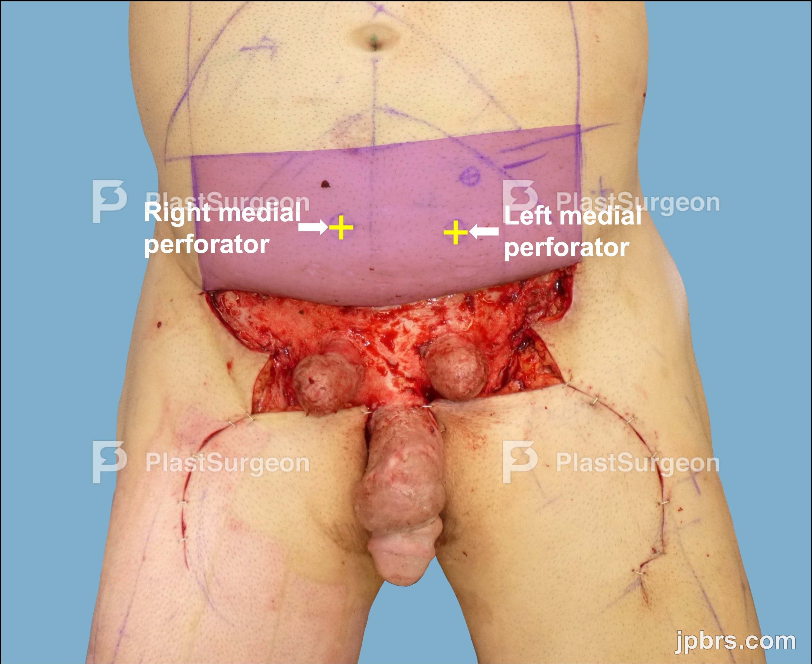 Dissection of the rotational flaps for reconstruction of the distal defect: