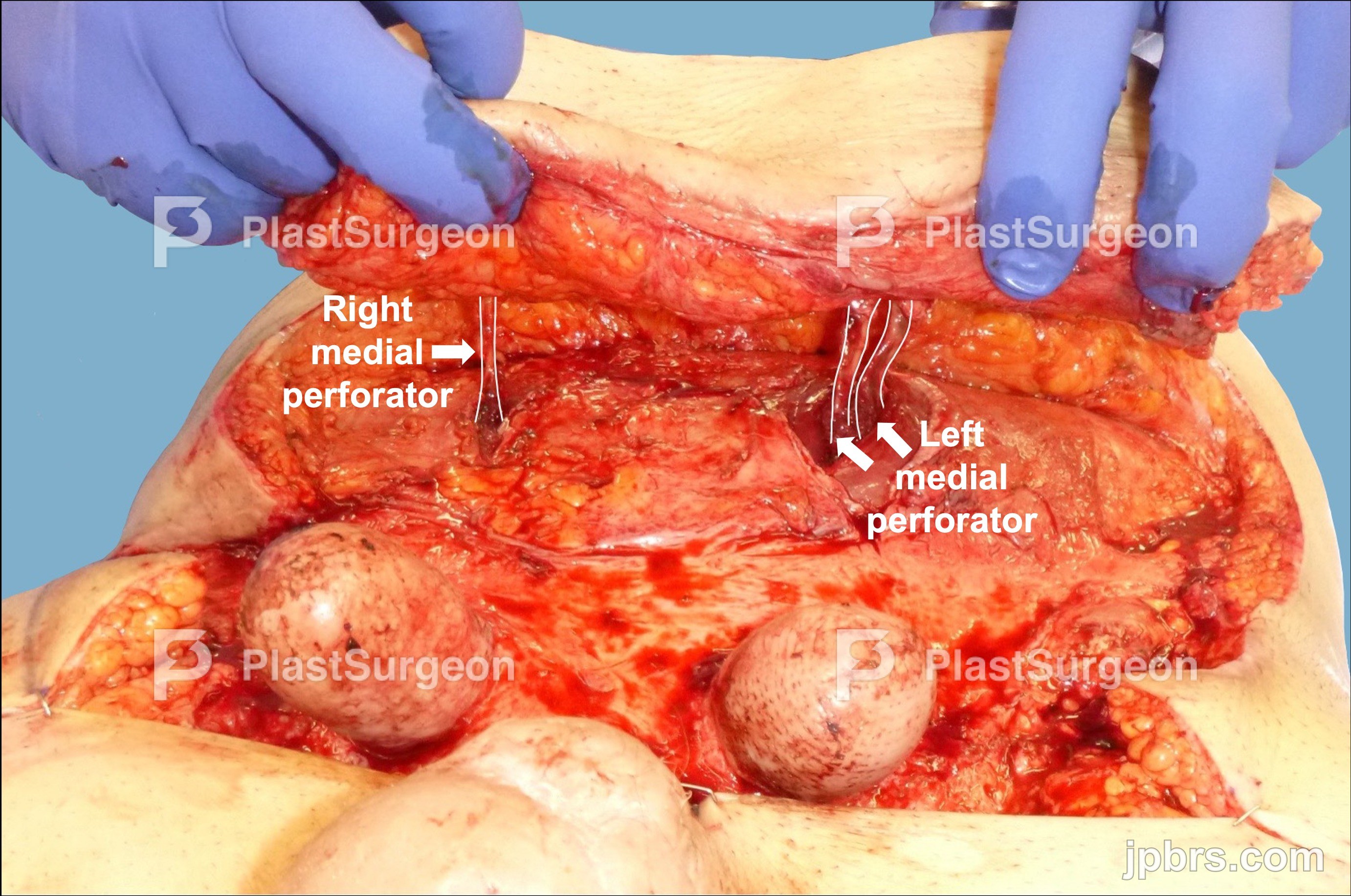 Dissection of the DIEP flap for reconstruction of the proximal defect: